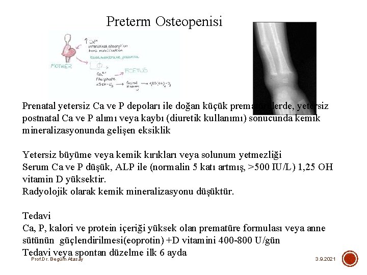 Preterm Osteopenisi Prenatal yetersiz Ca ve P depoları ile doğan küçük prematürelerde, yetersiz postnatal