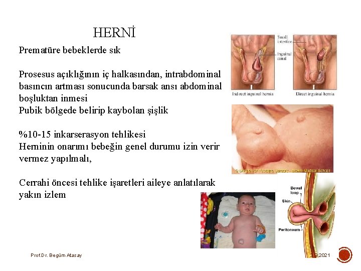 HERNİ Prematüre bebeklerde sık Prosesus açıklığının iç halkasından, intrabdominal basıncın artması sonucunda barsak ansı