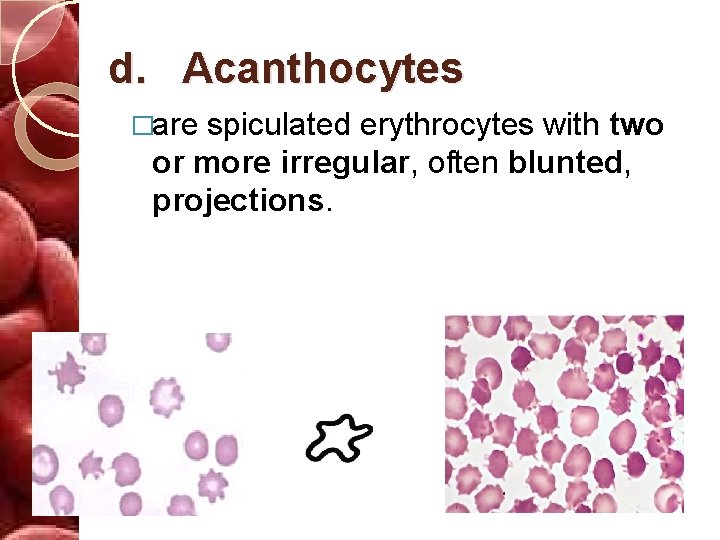 d. Acanthocytes �are spiculated erythrocytes with two or more irregular, often blunted, projections. 