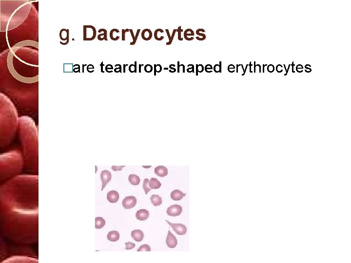 g. Dacryocytes �are teardrop-shaped erythrocytes 