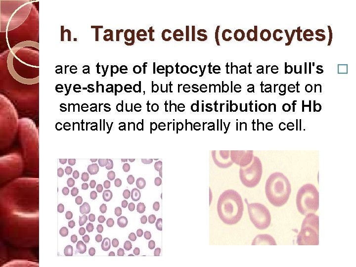 h. Target cells (codocytes) are a type of leptocyte that are bull's � eye-shaped,