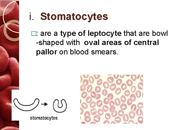 i. Stomatocytes �: are a type of leptocyte that are bowl -shaped with oval