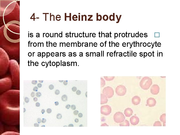 4 - The Heinz body is a round structure that protrudes � from the