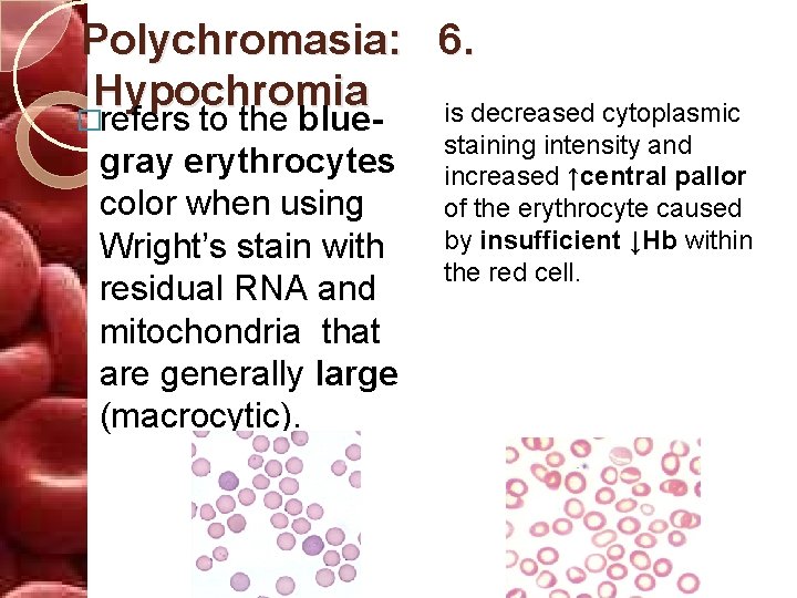 Polychromasia: 6. Hypochromia is decreased cytoplasmic �refers to the bluegray erythrocytes color when using