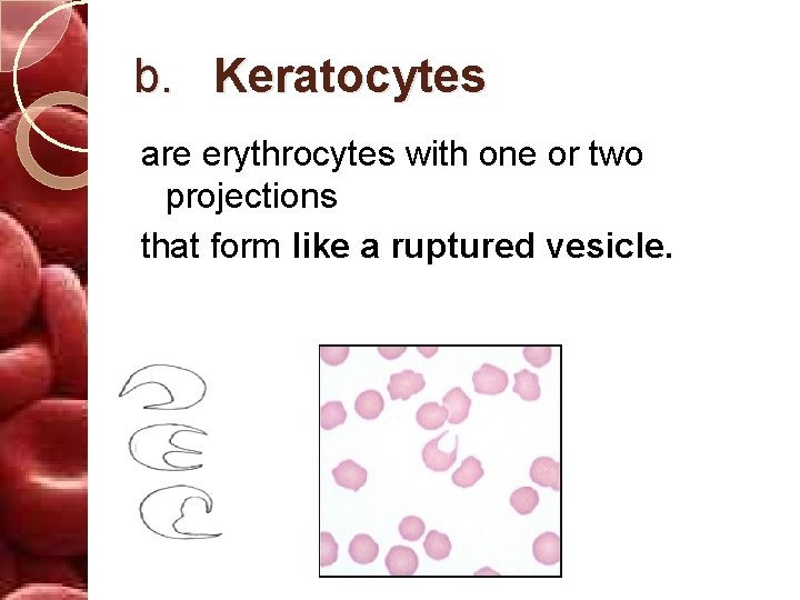 b. Keratocytes are erythrocytes with one or two projections that form like a ruptured