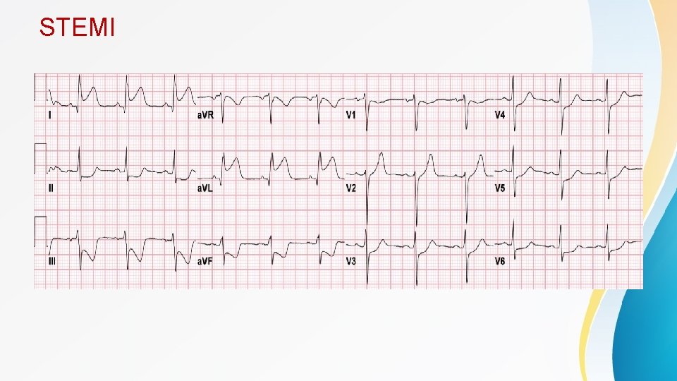 STEMI 