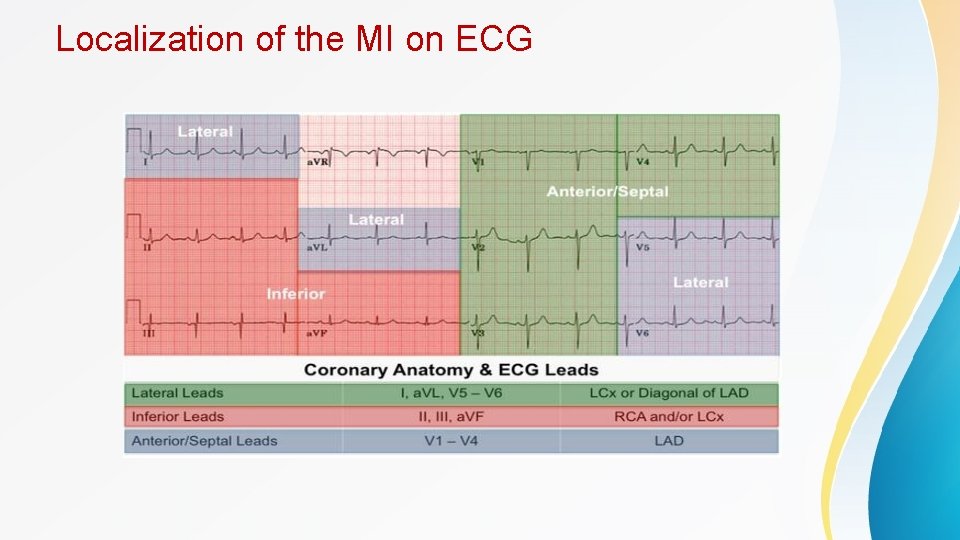 Localization of the MI on ECG 