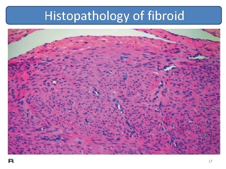 Histopathology of fibroid 17 