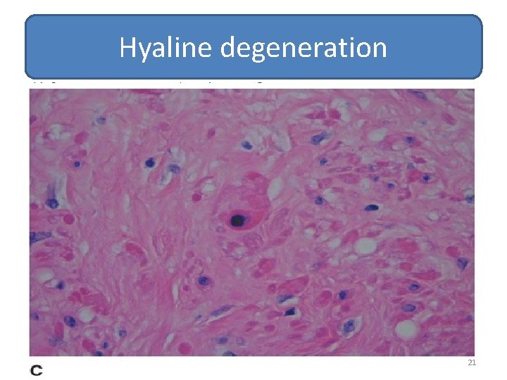 Hyaline degeneration 21 