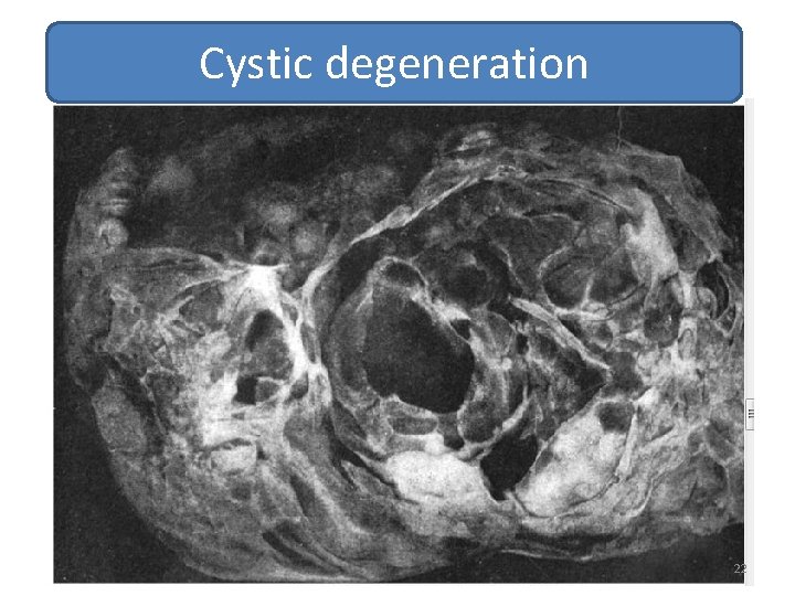 Cystic degeneration 22 