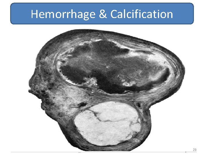 Hemorrhage & Calcification 23 