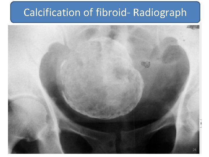 Calcification of fibroid- Radiograph 24 