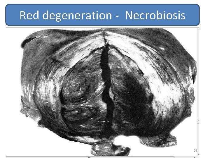 Red degeneration - Necrobiosis 25 