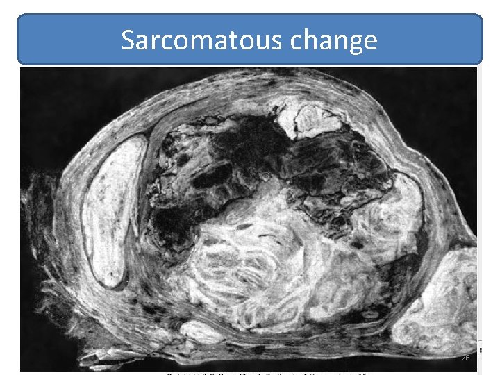 Sarcomatous change 26 