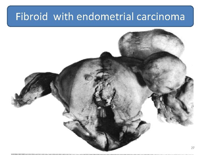 Fibroid with endometrial carcinoma 27 