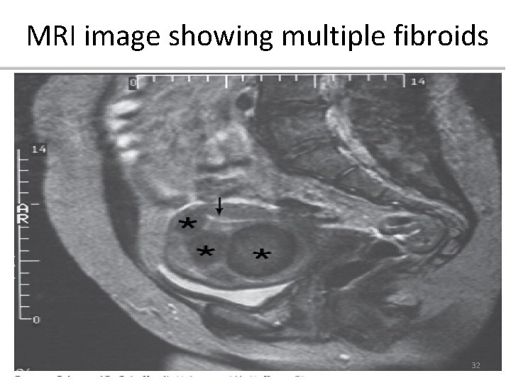 MRI image showing multiple fibroids 32 