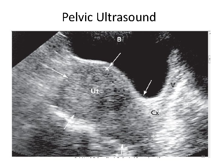 Pelvic Ultrasound 33 