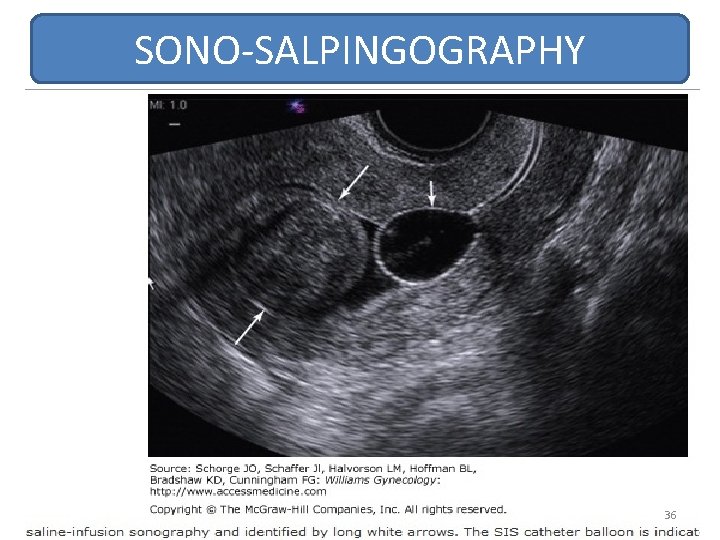 SONO-SALPINGOGRAPHY 36 