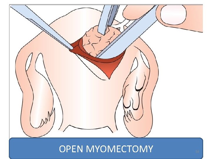 OPEN MYOMECTOMY 54 