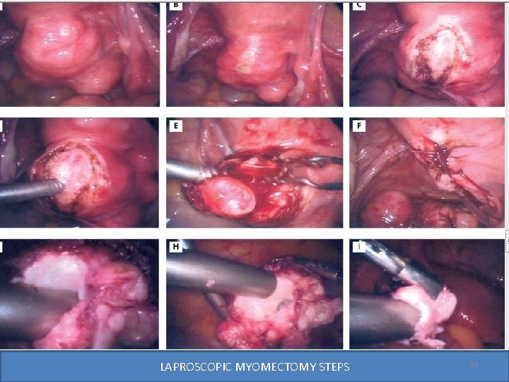 LAPROSCOPIC MYOMECTOMY STEPS 55 