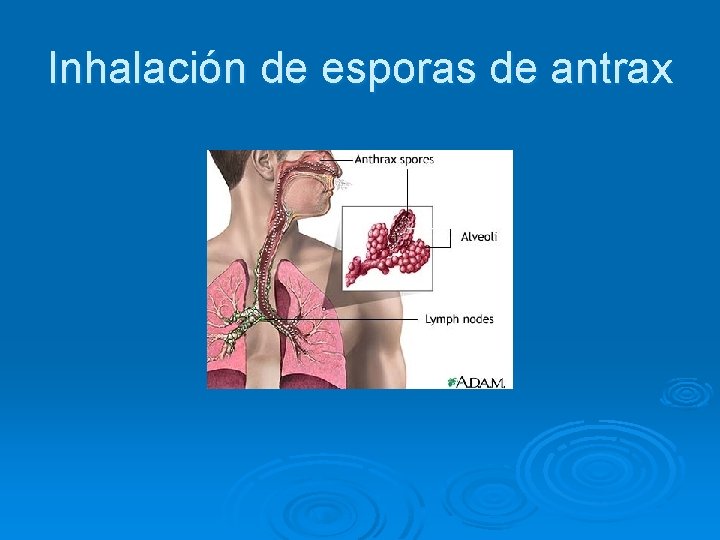 Inhalación de esporas de antrax 
