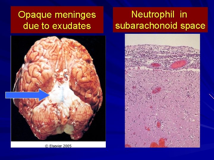 Opaque meninges due to exudates Neutrophil in subarachonoid space 