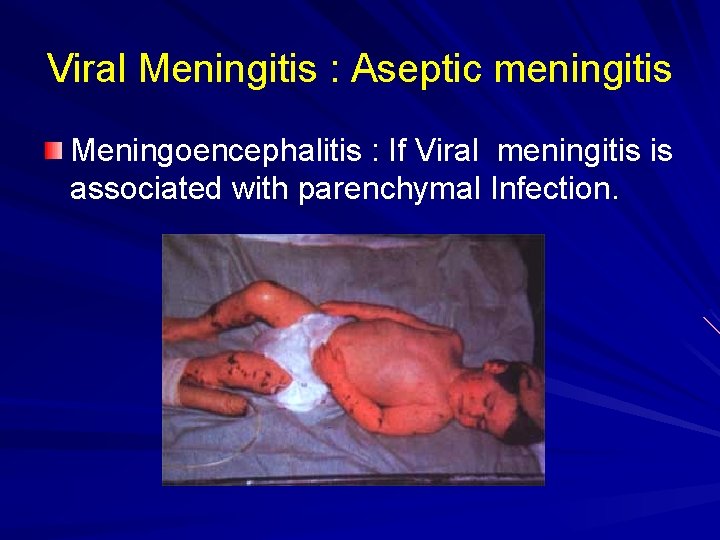 Viral Meningitis : Aseptic meningitis Meningoencephalitis : If Viral meningitis is associated with parenchymal