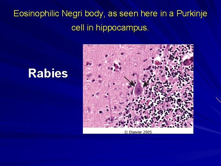 Eosinophilic Negri body, as seen here in a Purkinje cell in hippocampus. Rabies 