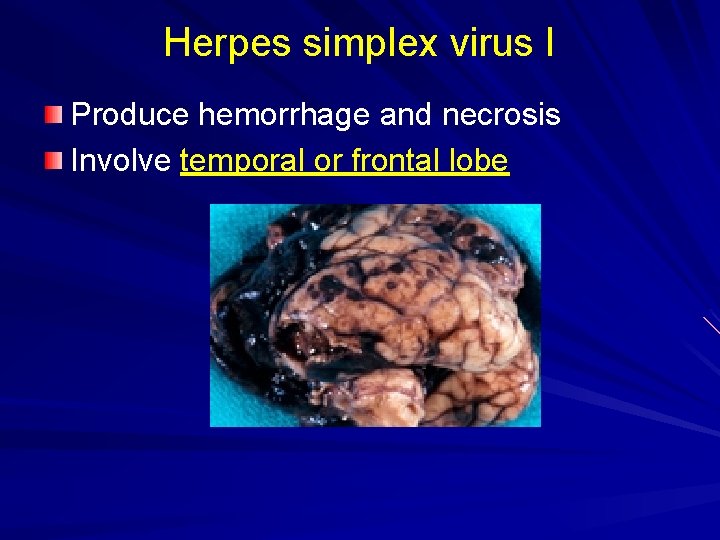 Herpes simplex virus I Produce hemorrhage and necrosis Involve temporal or frontal lobe 