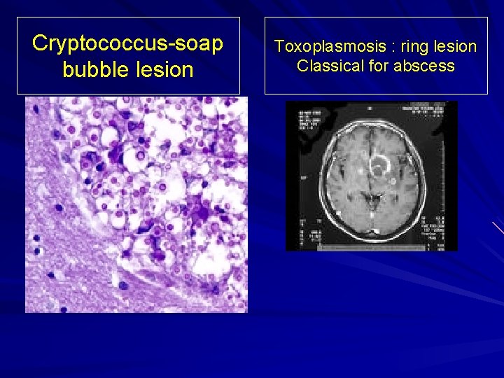 Cryptococcus-soap bubble lesion Toxoplasmosis : ring lesion Classical for abscess 