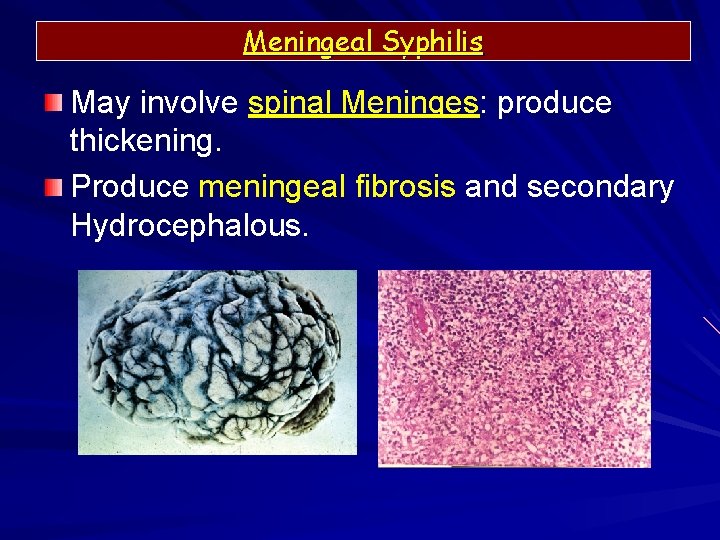 Meningeal Syphilis May involve spinal Meninges: produce thickening. Produce meningeal fibrosis and secondary Hydrocephalous.