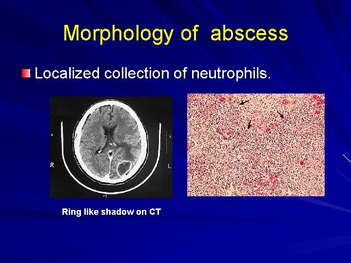 Morphology of abscess Localized collection of neutrophils. Ring like shadow on CT 