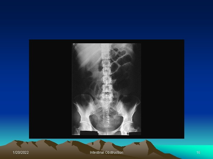 1/20/2022 Intestinal Obstruction 16 