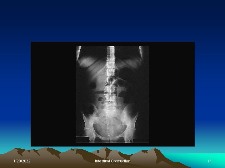 1/20/2022 Intestinal Obstruction 17 