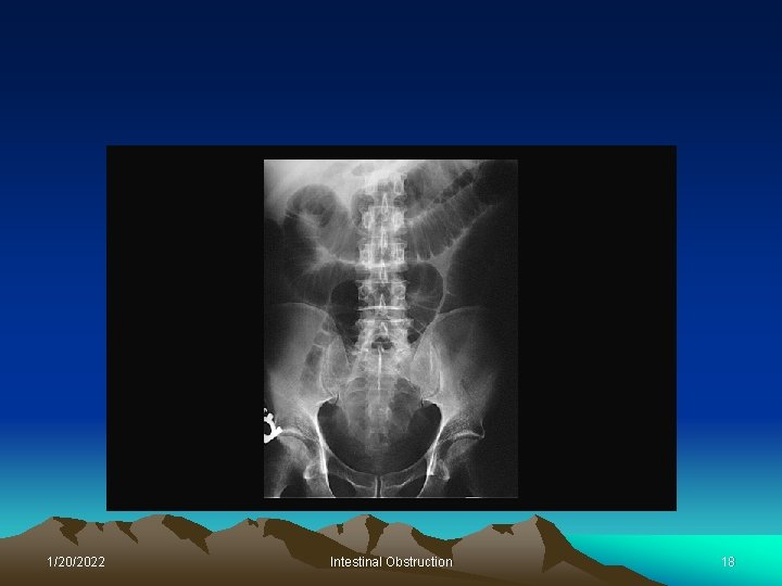 1/20/2022 Intestinal Obstruction 18 