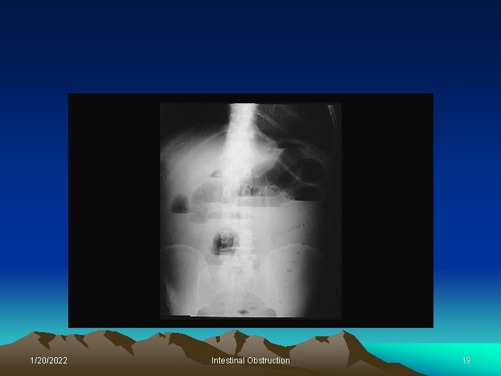 1/20/2022 Intestinal Obstruction 19 