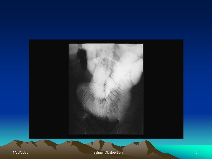 1/20/2022 Intestinal Obstruction 21 