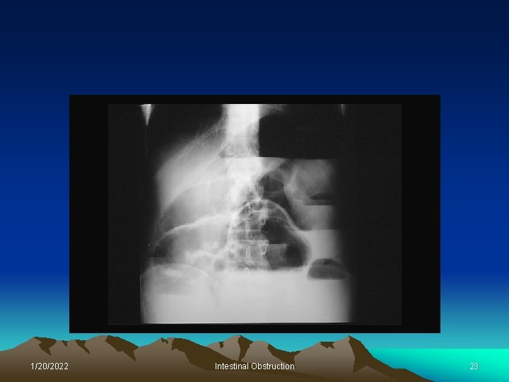 1/20/2022 Intestinal Obstruction 23 