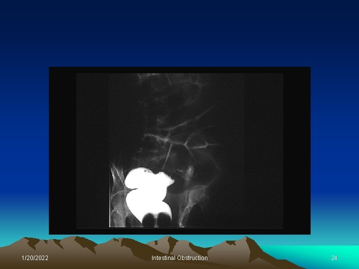 1/20/2022 Intestinal Obstruction 24 