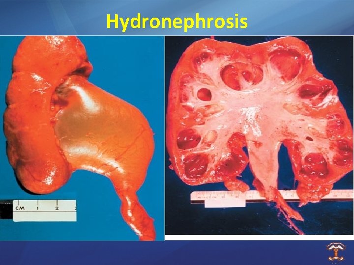 Hydronephrosis 