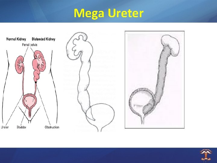 Mega Ureter 