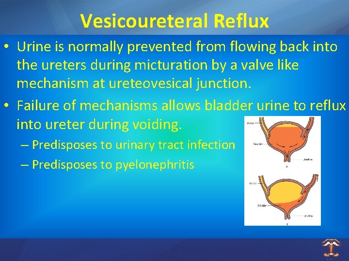 Vesicoureteral Reflux • Urine is normally prevented from flowing back into the ureters during