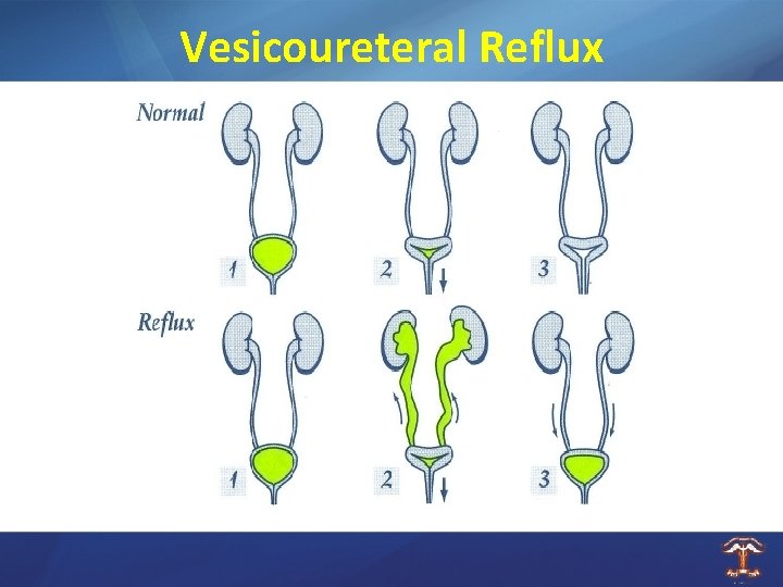 Vesicoureteral Reflux 