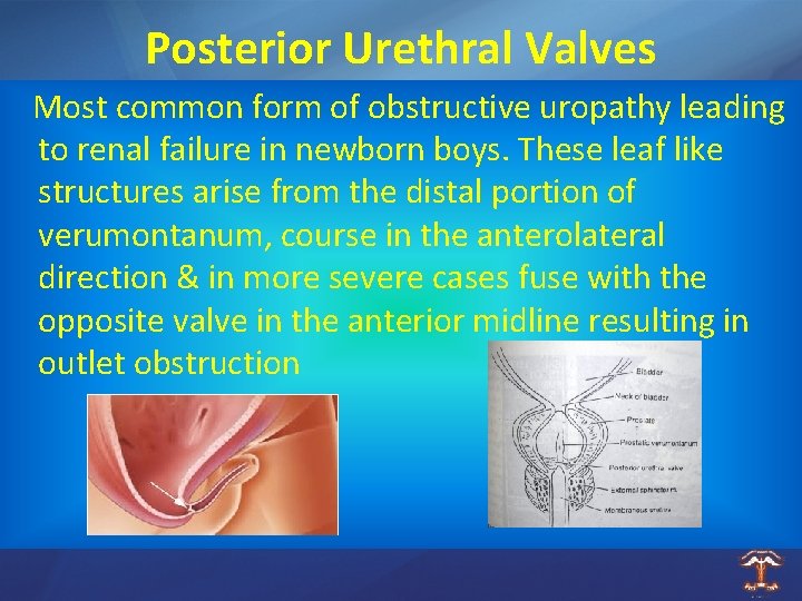 Posterior Urethral Valves Most common form of obstructive uropathy leading to renal failure in