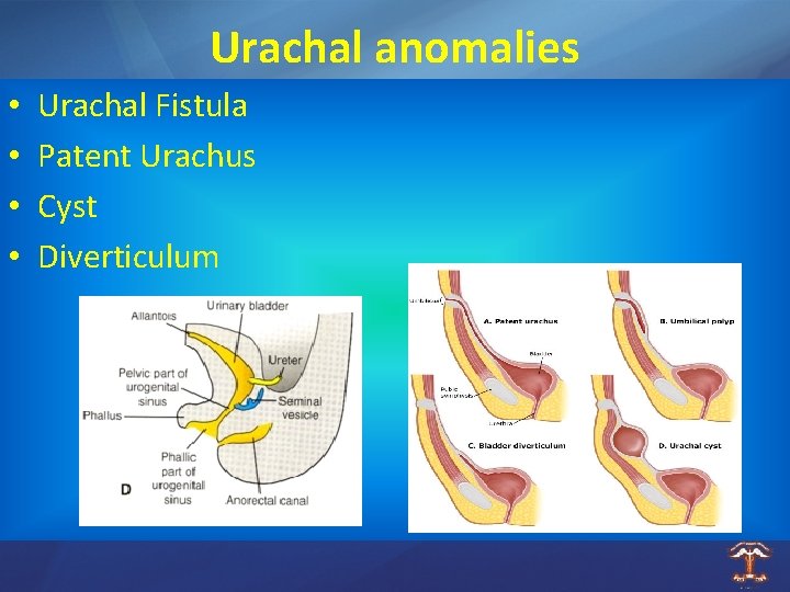 Urachal anomalies • • Urachal Fistula Patent Urachus Cyst Diverticulum 