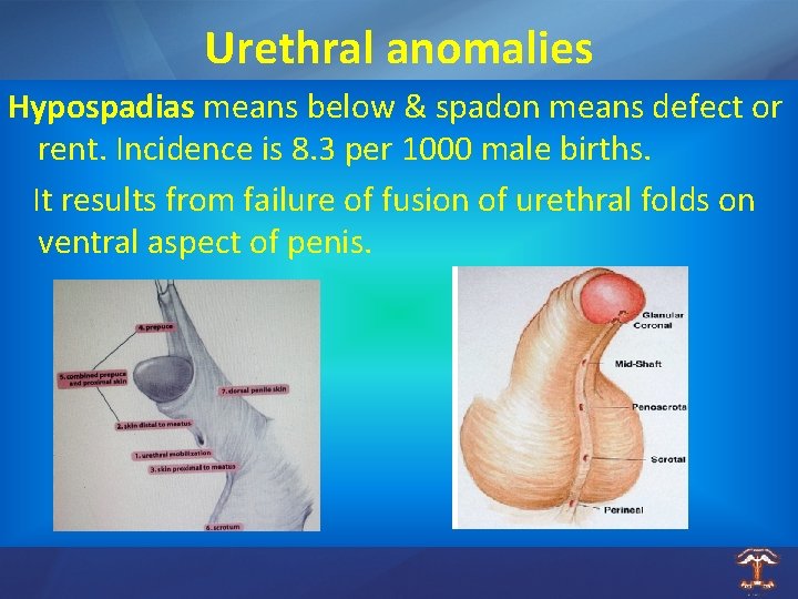 Urethral anomalies Hypospadias means below & spadon means defect or rent. Incidence is 8.