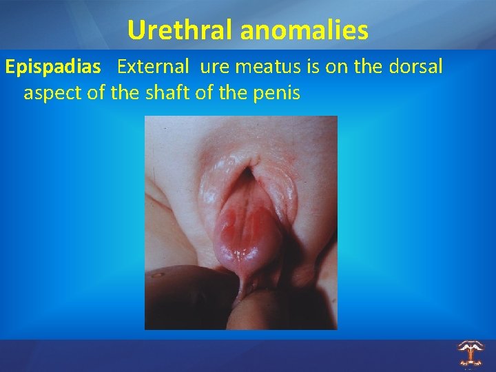 Urethral anomalies Epispadias External ure meatus is on the dorsal aspect of the shaft