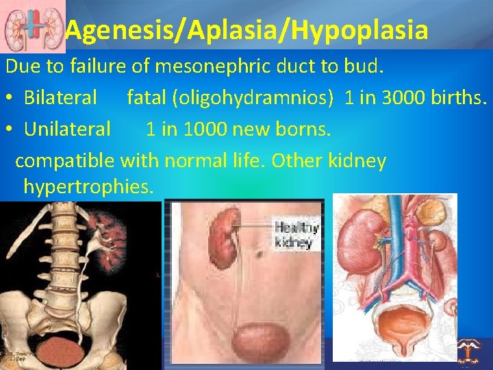 Agenesis/Aplasia/Hypoplasia Due to failure of mesonephric duct to bud. • Bilateral fatal (oligohydramnios) 1