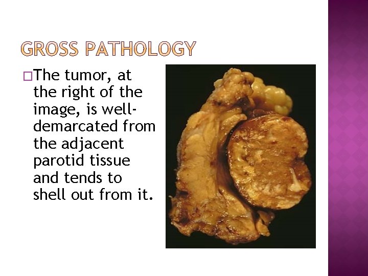 �The tumor, at the right of the image, is welldemarcated from the adjacent parotid