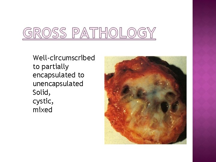 GROSS PATHOLOGY Well-circumscribed to partially encapsulated to unencapsulated Solid, cystic, mixed 